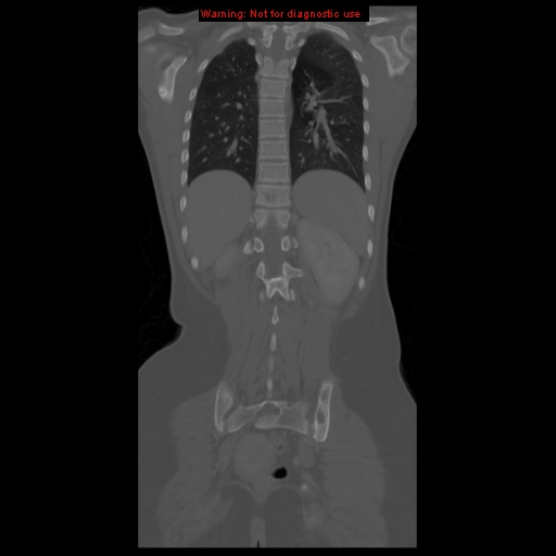 File:Brown tumor (Radiopaedia 12318-12596 D 49).jpg