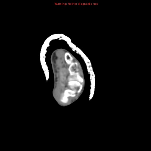 Brown tumor (Radiopaedia 12460-12694 Axial non-contrast 1).jpg