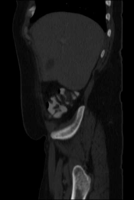 Brown tumors compressing the spinal cord (Radiopaedia 68442-77988 H 12).jpg