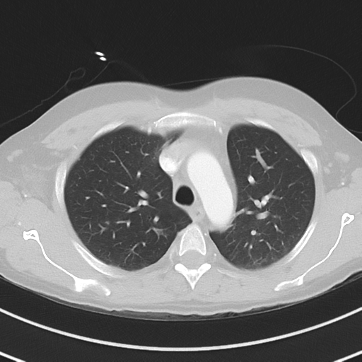 Burkitt lymphoma (Radiopaedia 34686-36121 Axial lung window 15).png
