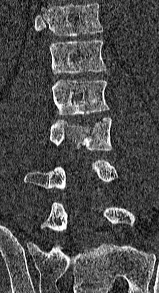 Burst fracture (Radiopaedia 53373-59357 Coronal bone window 42).jpg