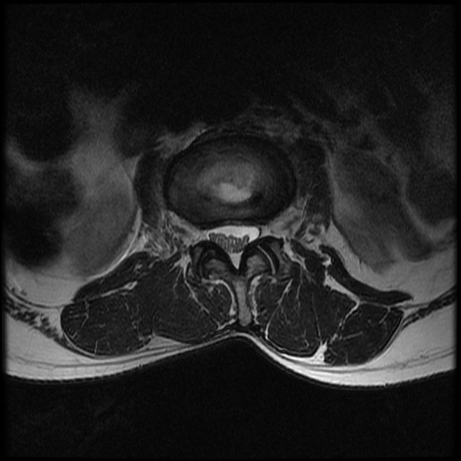 File:Burst fracture - lumbar spine (Radiopaedia 72877-83541 Axial T2 6).jpg