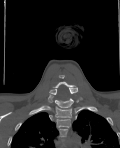 Butterfly vertebra (Radiopaedia 77903-90209 Coronal bone window 53).jpg
