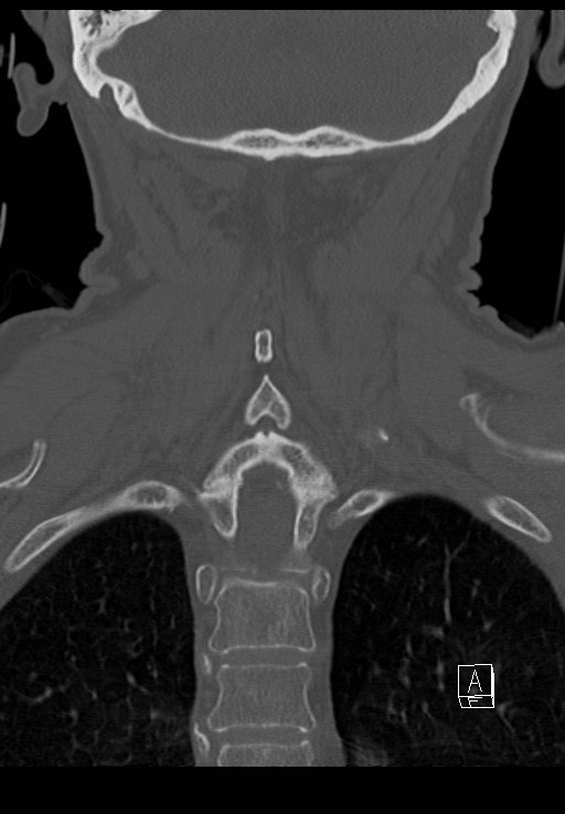 C1 and C2 (peg) fractures (Radiopaedia 36618-38184 Coronal bone window 39).jpg