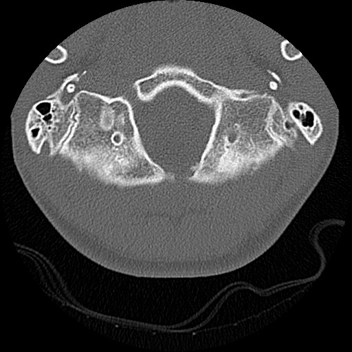 File:C5 facet fracture (Radiopaedia 58374-65499 Axial bone window 6).jpg