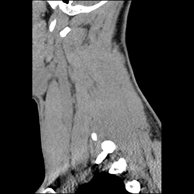 C5 facet fracture (Radiopaedia 58374-65499 D 19).jpg