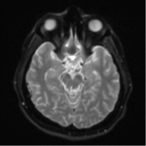 File:CNS vasculitis (Radiopaedia 55715-62263 Axial DWI 11).png