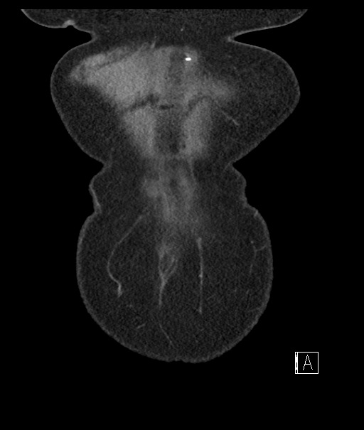 Calcified adrenal glands and Spigelian hernia (Radiopaedia 49741-54988 B 8).jpg