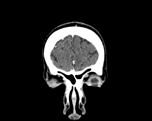 File:Calcified cerebral hydatid cyst (Radiopaedia 65603-74717 C 3).jpg