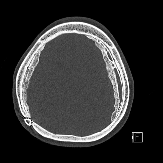 Calcified chronic subdural hematoma (Radiopaedia 77374-89492 Axial bone window 101).jpg