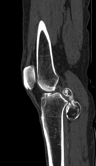 Calcified hematoma - popliteal fossa (Radiopaedia 63938-72763 Sagittal bone window 34).jpg