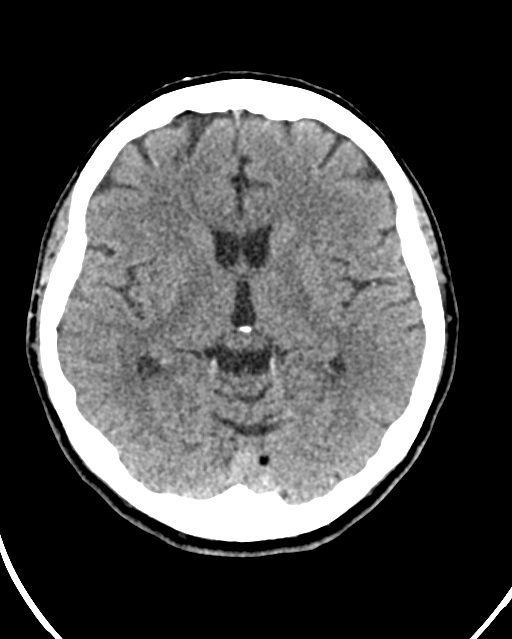 Calcified meningioma (Radiopaedia 74361-85243 Axial non-contrast 27).jpg