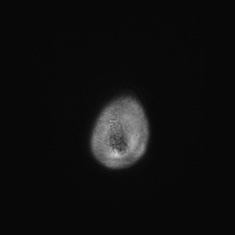 Callosal dysgenesis with interhemispheric cyst (Radiopaedia 53355-59335 Axial T1 160).jpg