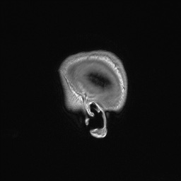 Callosal dysgenesis with interhemispheric cyst (Radiopaedia 53355-59335 Sagittal T1 168).jpg