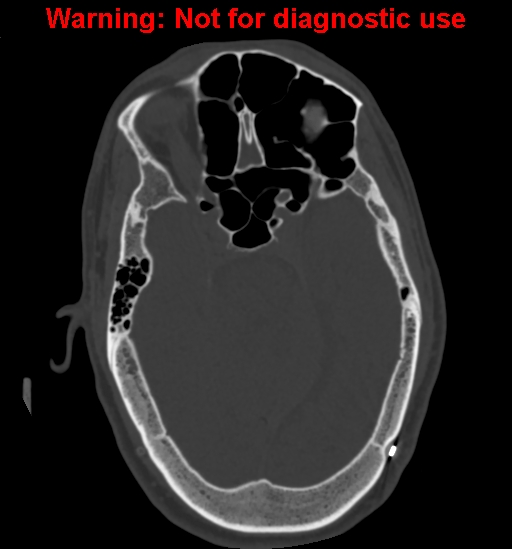 Calvarial thickening from chronic shunting (Radiopaedia 60079-67637 Axial bone window 66).jpg
