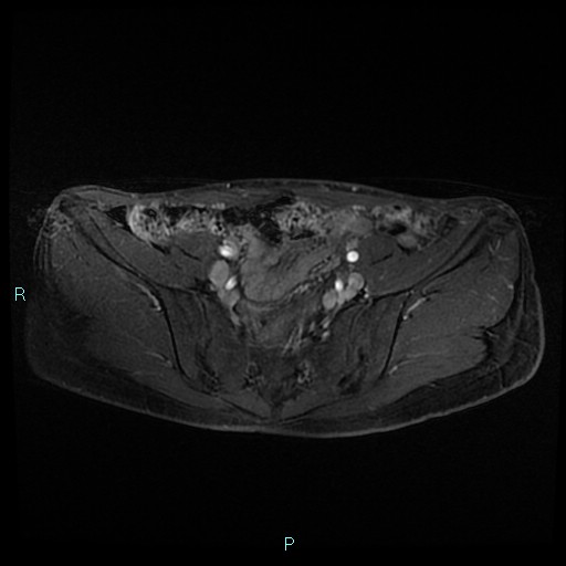 File:Canal of Nuck cyst (Radiopaedia 55074-61448 Axial T1 C+ fat sat 13).jpg