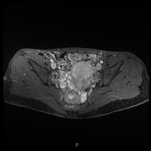 File:Canal of Nuck cyst (Radiopaedia 55074-61448 Axial T1 C+ fat sat 28).jpg