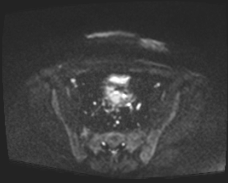 Cancer cervix - stage IIb (Radiopaedia 75411-86615 Axial DWI 51).jpg