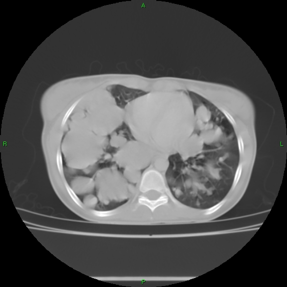 File:Cannon ball metastases - synovial sarcoma (Radiopaedia 26135-26271 Axial lung window 23).jpg