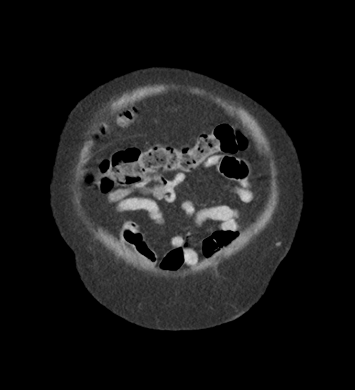 Cannonball metastases from endometrial cancer (Radiopaedia 42003-45031 F 10).png