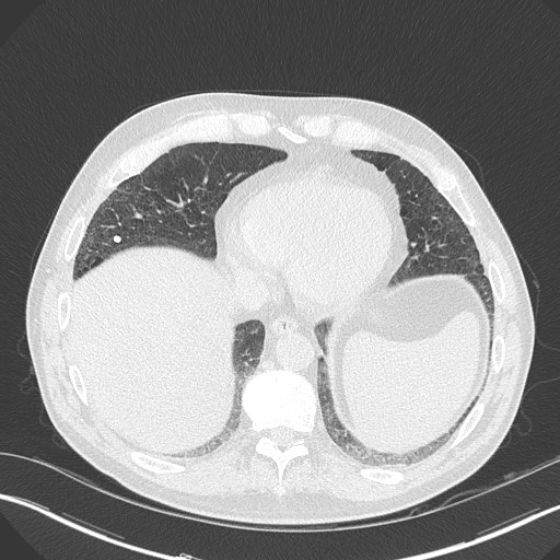 Caplan syndrome (Radiopaedia 56667-63530 Axial lung window 149).jpg