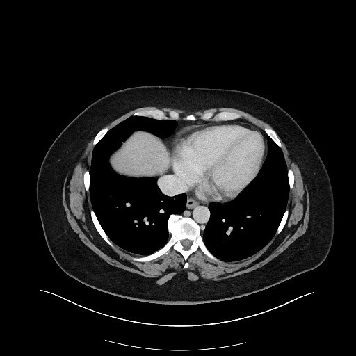 Carcinoid tumor - terminal ileum (Radiopaedia 60931-68739 A 8).jpg