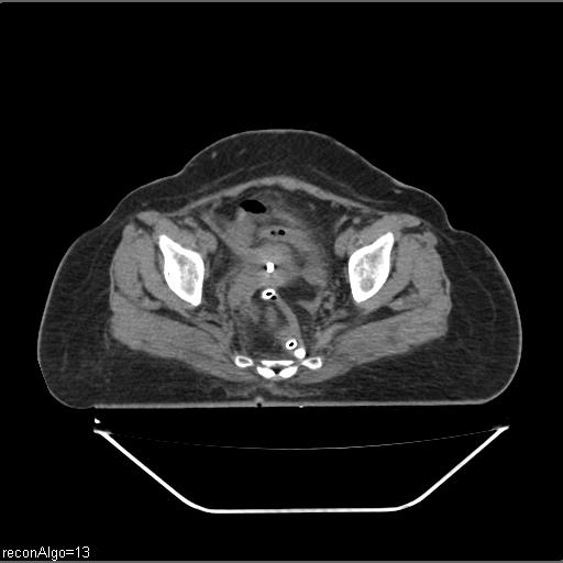 Carcinoma cervix- brachytherapy applicator (Radiopaedia 33135-34173 Axial non-contrast 27).jpg