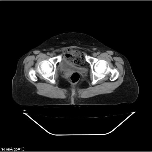 File:Carcinoma cervix- recurrence (Radiopaedia 34702-36137 Axial non-contrast 49).jpg