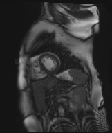 Cardiac amyloidosis (Radiopaedia 51404-57150 Sagittal CINE SSFP 122).jpg
