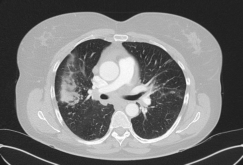 Cardiac sarcoidosis (Radiopaedia 74548-85534 Axial lung window 36).jpg