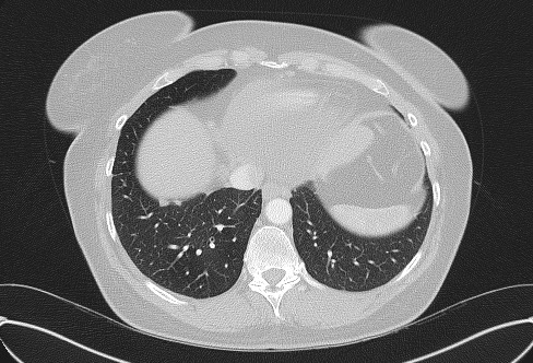 File:Cardiac sarcoidosis (Radiopaedia 74548-85534 Axial lung window 71).jpg