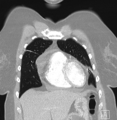 Cardiac sarcoidosis (Radiopaedia 74548-85534 Coronal lung window 12).jpg