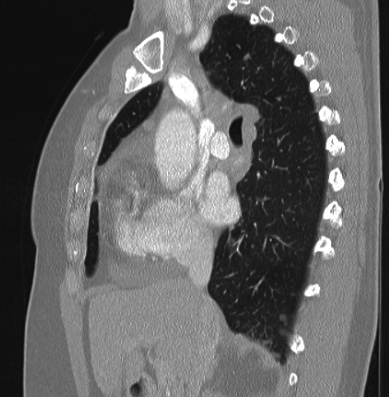 Cardiac sarcoidosis (Radiopaedia 74548-85534 Sagittal lung window 54).jpg