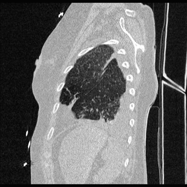 Cardiogenic pulmonary edema (Radiopaedia 29213-29609 Sagittal lung window 81).jpg