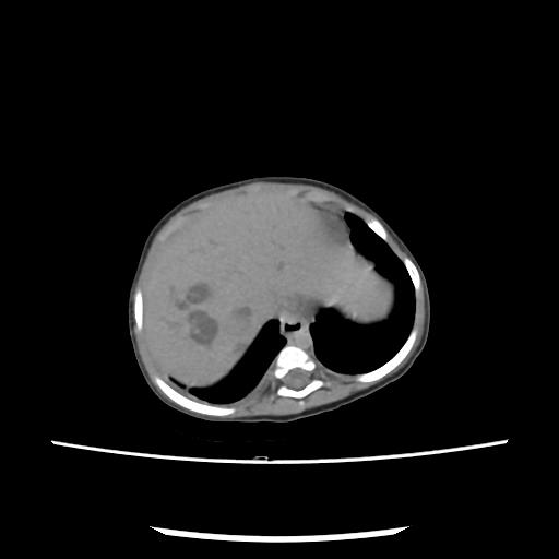 Caroli disease with autosomal recessive polycystic kidney disease (ARPKD) (Radiopaedia 89651-106703 E 24).jpg
