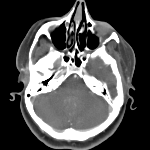 Carotico ophthalmic aneurysm (Radiopaedia 42916-46148 A 41).png