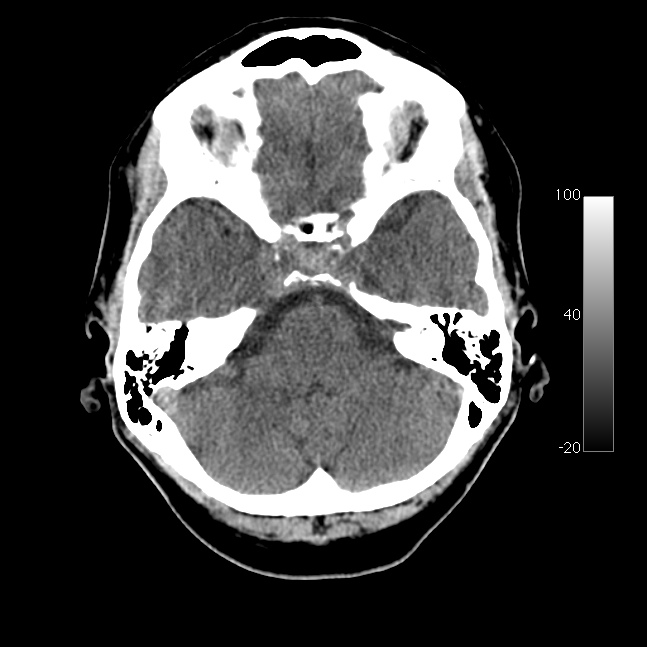 Caroticocavernous fistula (Radiopaedia 14617-14542 Axial non-contrast 8).jpg