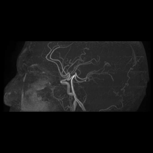 Carotid arterial dissection with acute cerebral infarction (Radiopaedia 26636-26784 MRA 2).jpg