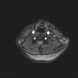 Carotid artery dissection (Radiopaedia 28441-28689 Axial MRA 32).jpg