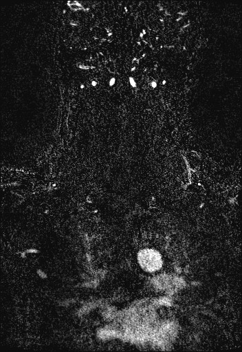 Carotid artery dissection (Radiopaedia 28441-28689 Coronal MRA 74).jpg