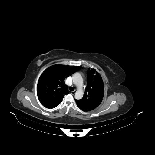 File:Carotid body tumor (Radiopaedia 21021-20948 B 33).jpg