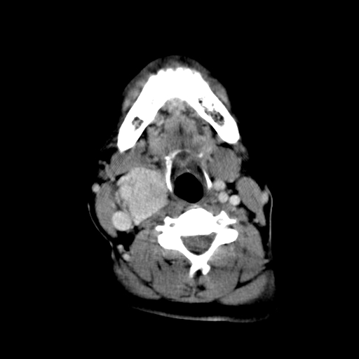 File:Carotid body tumor (Radiopaedia 27890-28124 A 17).jpg