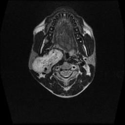 File:Carotid body tumor (Radiopaedia 30208-30823 Axial T2 11).jpg