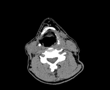 File:Carotid body tumor (Radiopaedia 61750-69757 Axial non-contrast 62).jpg