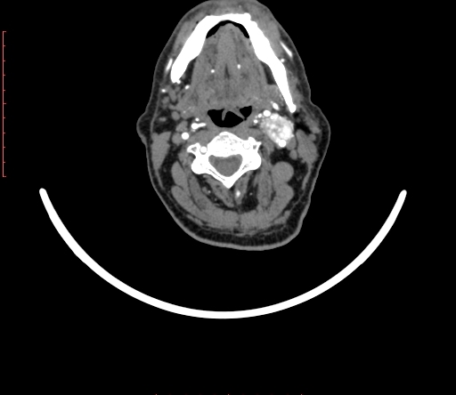Carotid body tumor (Radiopaedia 66785-76116 B 29).jpg