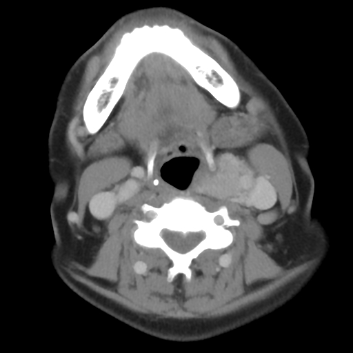 Carotid body tumor (paraganglioma) (Radiopaedia 38586-40729 A 19).jpg