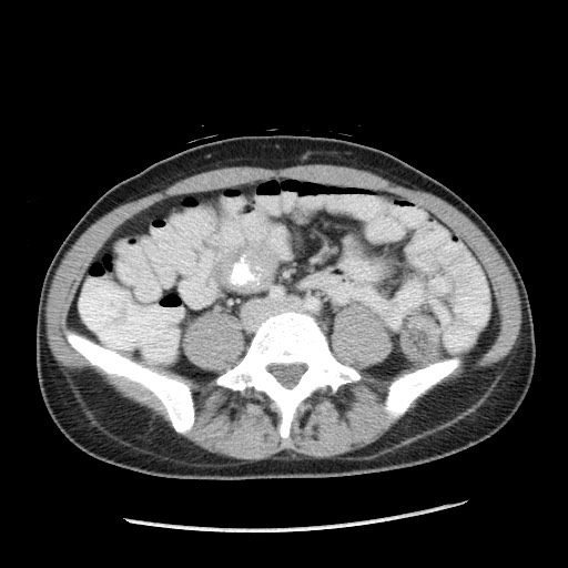 File:Castleman disease with fibrous pseudotumor in the abdomen (Radiopaedia 77296-89373 A 77).jpg