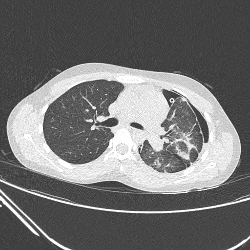 Catamenial pneumothorax (Radiopaedia 27946-28197 lung window 68).jpg