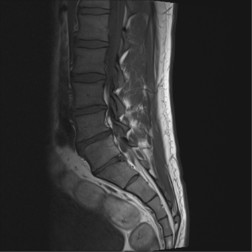 File:Cauda equina syndrome (Radiopaedia 53615-59672 Axial T1 10).png