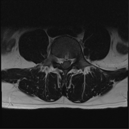 File:Cauda equina syndrome (Radiopaedia 53615-59672 Axial T2 15).png